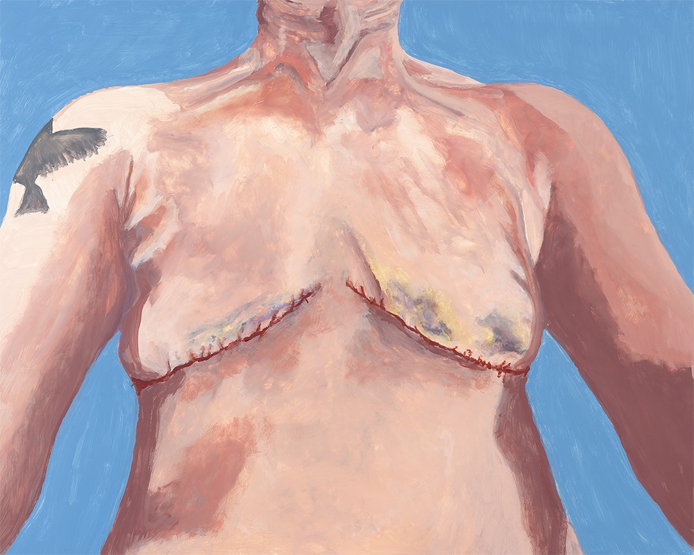 SELF PORTRAIT POST OP WITH STITCHES (2024) Oil / 16"x20"