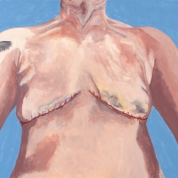 SELF PORTRAIT POST OP WITH STITCHES (2024) Oil / 16"x20"